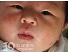 婴儿湿疹的症状（图片）
