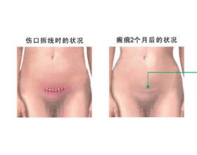 剖腹产疤痕如何消除 剖腹产后疤痕图片