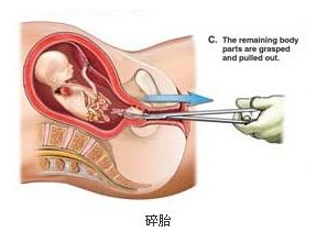 高清实拍：女人堕胎手术全过程(图片)