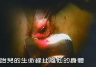 高清实拍:<em>女人堕胎</em>手术全过程(图片)(4) - 顺产|