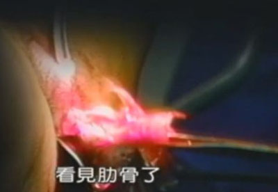 高清实拍:<em>女人堕胎手术全过程</em>(图片)(5) - 顺产|