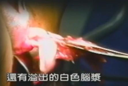 高清实拍:<em>女人堕胎手术全过程</em>(图片)(6) - 顺产|