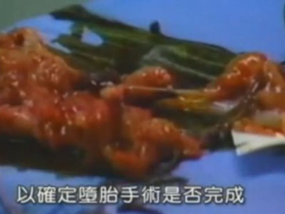 高清实拍:<em>女人堕胎手术全过程</em>(图片)(6) - 顺产|